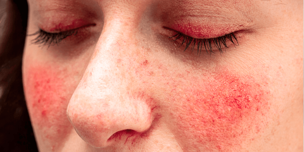 rosto de mulher com lúpus eritematoso sistêmico