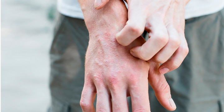 homem coçando a mão com sintoma de esclerose sistêmica