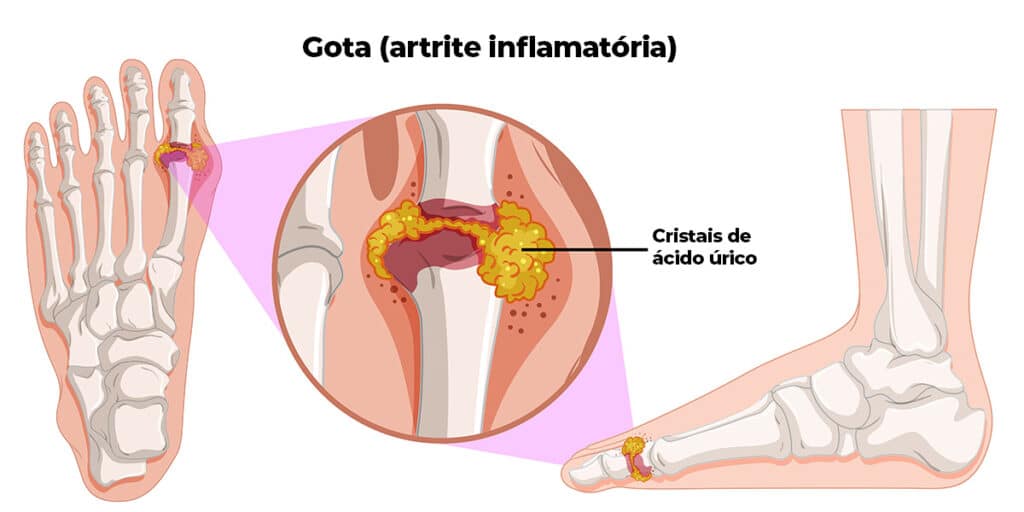 Deposição de cristais de ácido úrico no pé por conta da Gota - Dr. Marcelo Reumaologista
