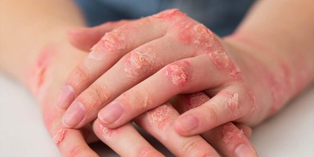 Artrite psoriática: uma doença reumática que afeta pessoas com psoríase.