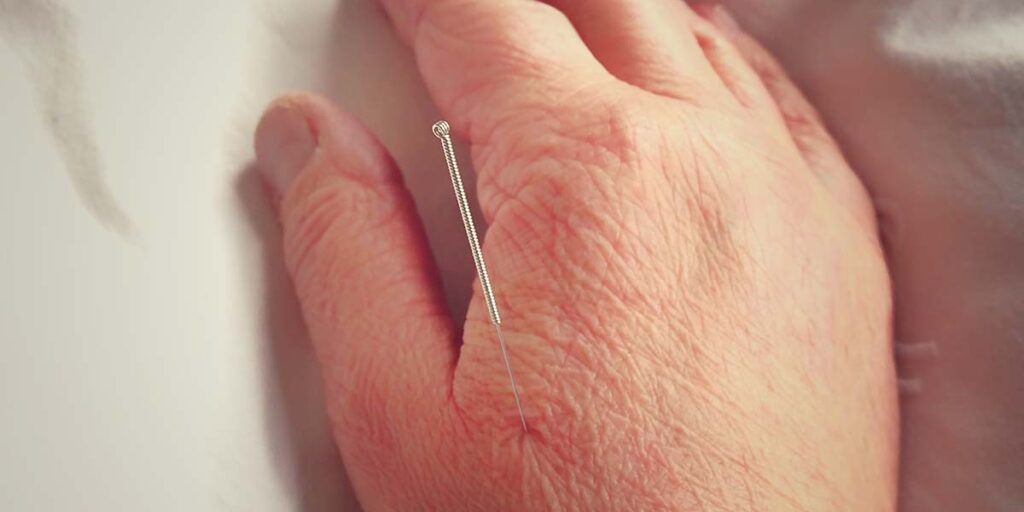 Mão com agulha de acupuntura - Dr. Marcelo José Uchoa Corrêa Reumatologista de Belém - PA